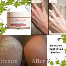 Urea Cream 42 For Rough Skin Plus 2 Salicylic Acid