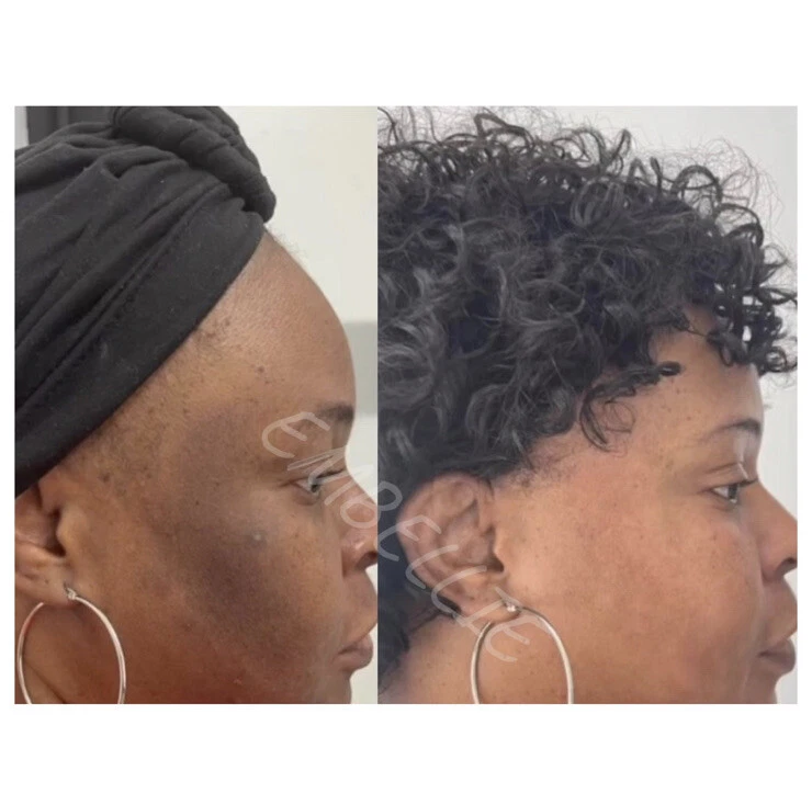 Aceite sérico removedor de quemaduras solares, suero Dark Mark Fade Foto 3 de 4