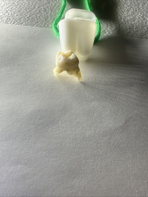 A Human Tooth Pulled With Pliers With Necklace Carrier