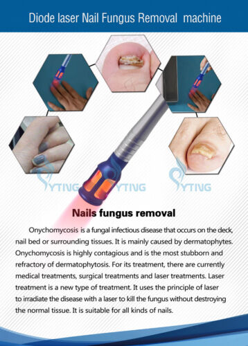 Máquina de eliminación de hongos en uñas láser diodo 980nm tratamiento de infección en uñas de los pies - Imagen 5 de 9