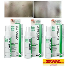 3 Oxe Cure Body Spray Reduce Blemish Treatment Acne on Back Chest Neck Skin 50ml