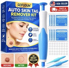 Auto Micro Skin Tag Remover Kit 2-8mm Painless Safe Removal Device Tool Bands