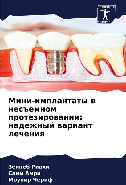 Zeineb Riahi (U. A.) | Mini-Implantaty W Nes Emnom Protezirowanii: Nadezhnyj...-image