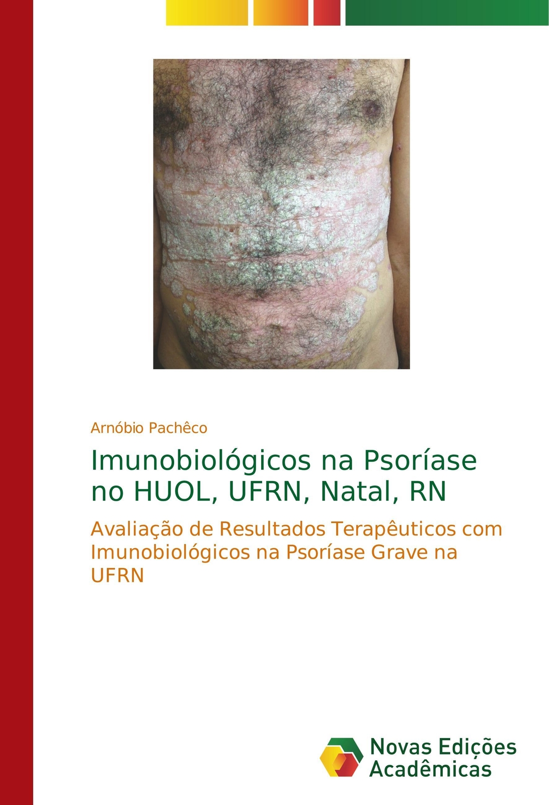 Thumbnail - Imunobiológicos Na Psoríase No Huol, Ufrn, Natal, Rn Arnóbio Pachêco