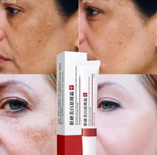 2pcs Whitening Freckle Cream Remove Melasma Acne Spot Pigment Melanin Face Cream