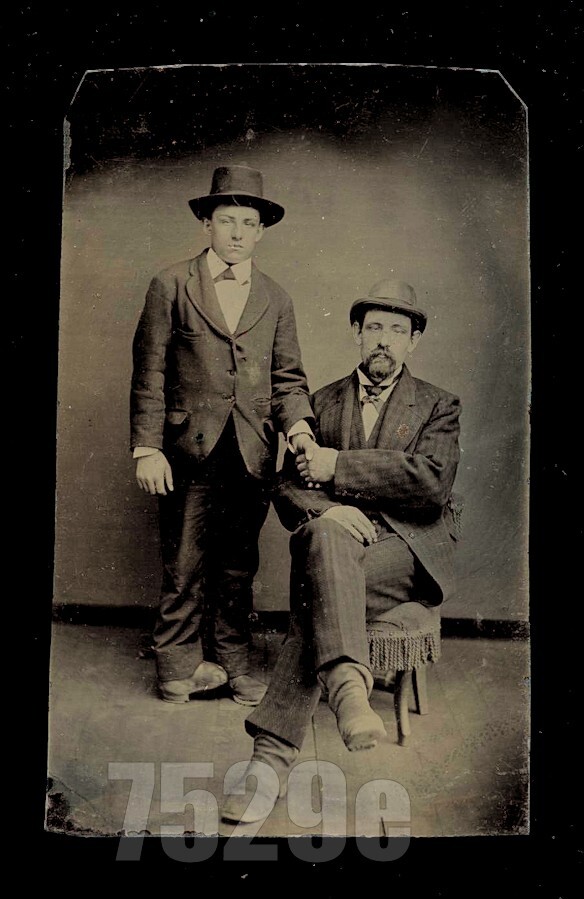 A genuinely rare 19th-century medical-interest tintype capturing a tender, historically poignant father-son moment that doubles as a window into Victorian-era disability documentation.