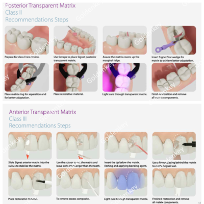 Dental Restoration Tools Dental Clear Anterior Matrix System ...