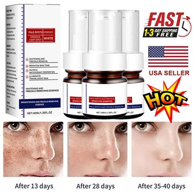 Whiting And Freckle Removing Serum Cream Dark Spot Remover Freckle Cream Serum