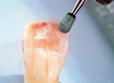 Dura-Green TC4 tapered cone HP (handpiece), 12/pk #0042