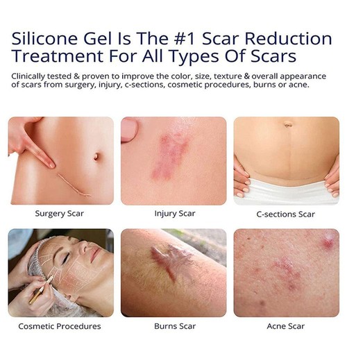 Silicone Scar Gel Stretch Marks Removal Cream Skin Care Scars Treatment Cream - Picture 8 of 9