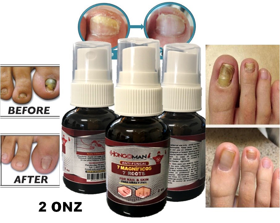 Antifungal Nail Polish