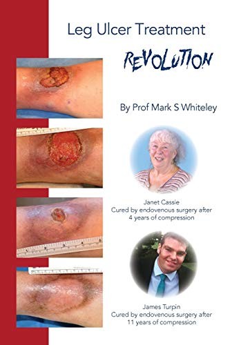 Leg Ulcer Treatment Revolution,Mark S Whiteley