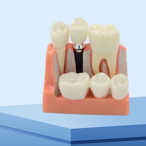 Flexible Dental Teeth Model Tooth Implant Model for Dentist Studying Teaching - Picture 3 of 8
