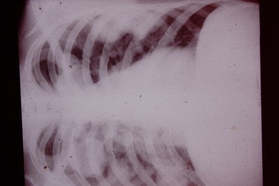 No Date Medical Slide X-Ray Mass Produced  Slide CD-L