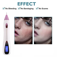 USB Charging Anti-Aging Laser Plasma Pen Dark Spot Tattoo Removal Skin Care Use