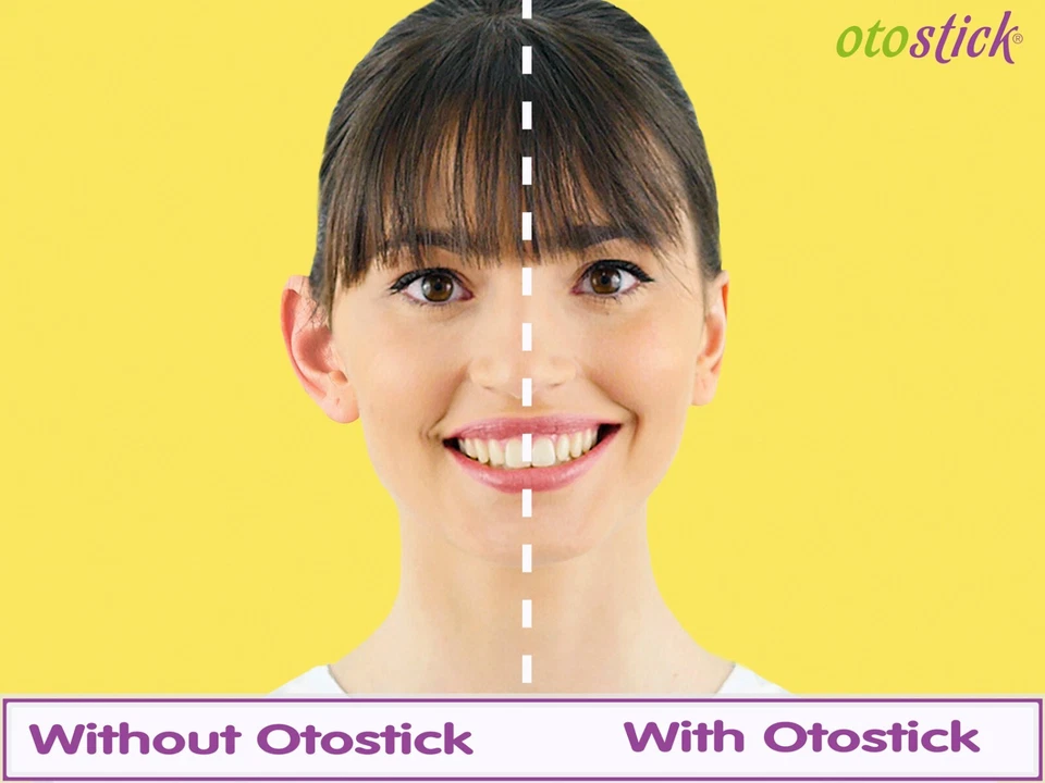 OTOSTICK BABY BIG BAT PROMINENT EAR CORRECTOR NONSURGERY OTOPLASTY Ear Pin - image 4 of 4