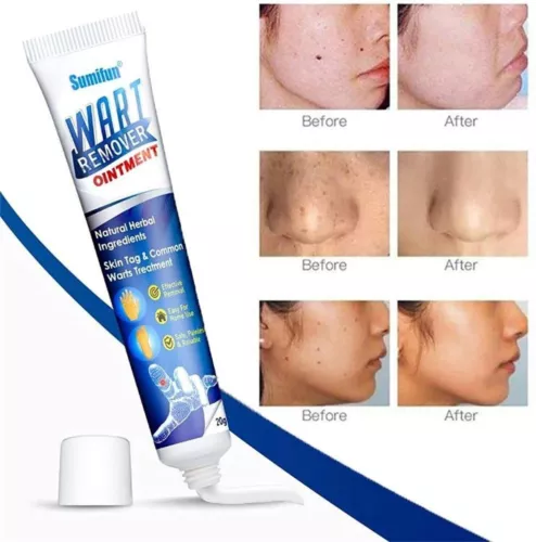 Warzen Entfernung Haut Tag Behandlung Creme Wart Remover Warze Entferner - Bild 6 von 21