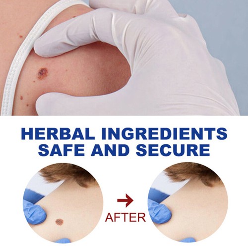 12 Hours Wart Remover Pen Skin Tag Mole Remover Eliminate Foot Corn Warts Unisex - Picture 6 of 12