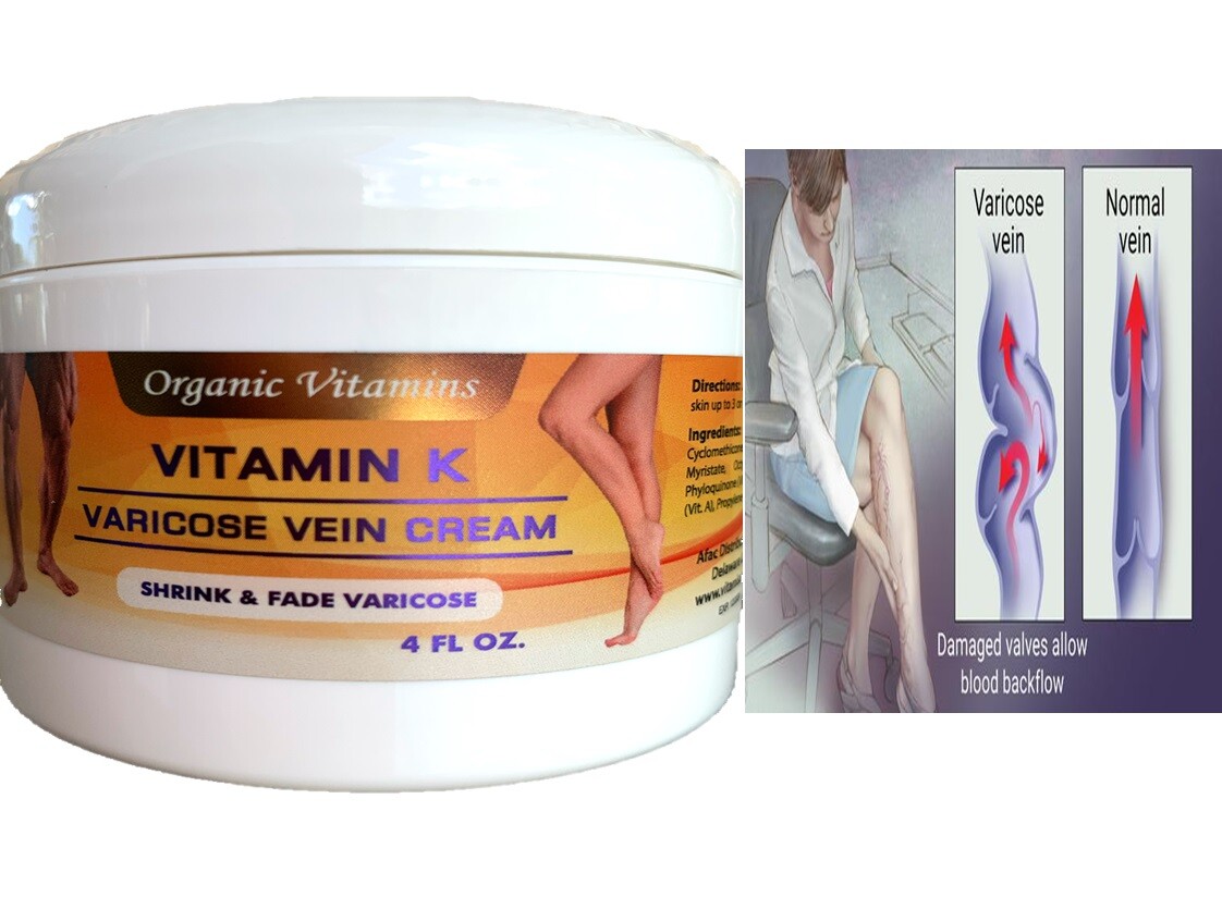 VITAMIN K CREAM THREAD SPIDER VARICOSE VEIN SCAR ROSACEA