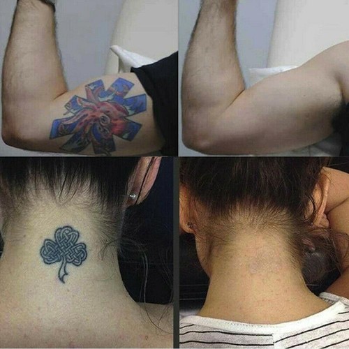 NEW Quick Tattoo Removal Fluid Permanent Corrector 10ml Pigment D1M3 A4V6 - Picture 8 of 9