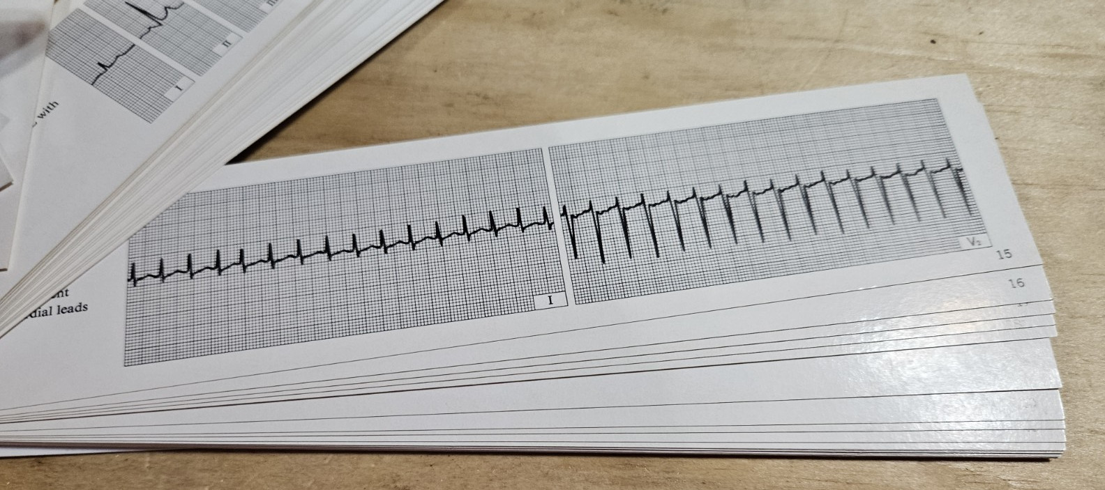 Vintage MERCK SHARP &DOHME THE ELECTROCARDIO GUIDE REPRESENTATIVE ECG CONDITIONS