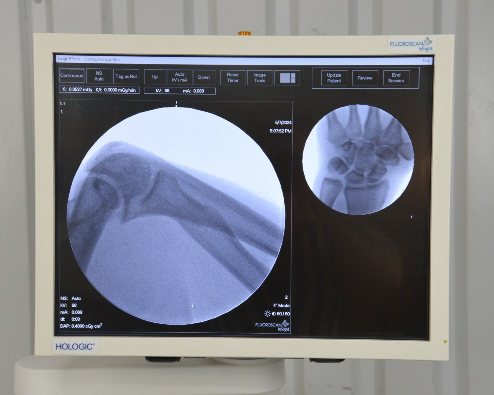 2011 Hologic Fluoroscan InSight 2 C-Arm Imaging System w/Wireless Footswitch