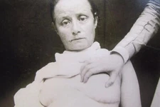 Antique Medical Breast Lumpectomy Photo 4675 Oddleys Strange & Bizarre