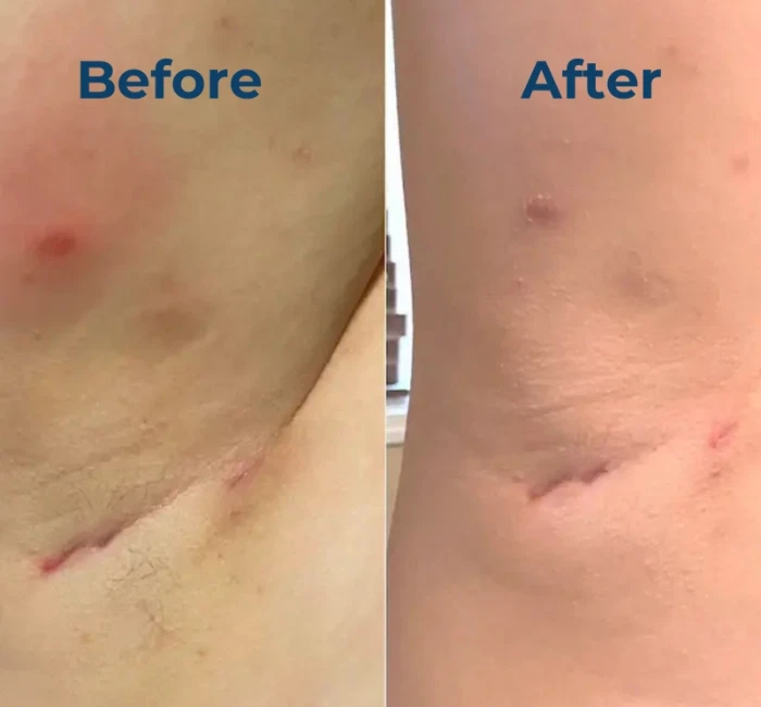 4 унц. Крем для гнойного гидраденита - Изображение 3 из 4