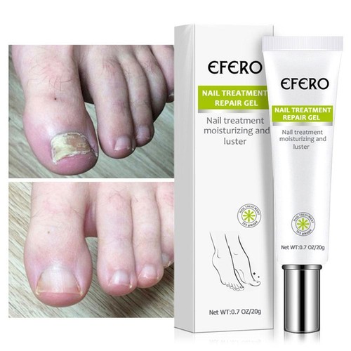EFERO Nail Anti Fungal Infection Gel Treatment Hand Foot Cream Toenail Remove - Picture 10 of 14
