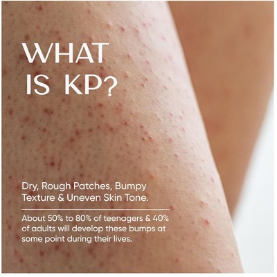 KP Bump Eraser Cream: Smooth Rough Skin