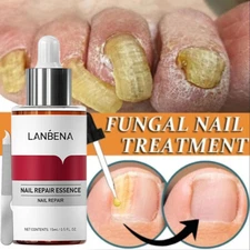 Nail Repair Serum Fungal Nail Treatment Liquid Remove Toe Nail Fungus Essence