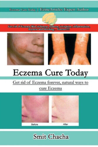 Thumbnail - Eczema Cure Today - Get Rid Of Eczema Forever Natural Ways To Cure