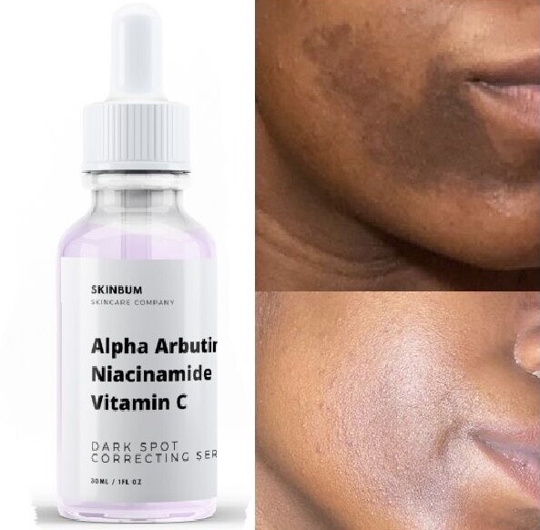 bleaching cream for dark spots