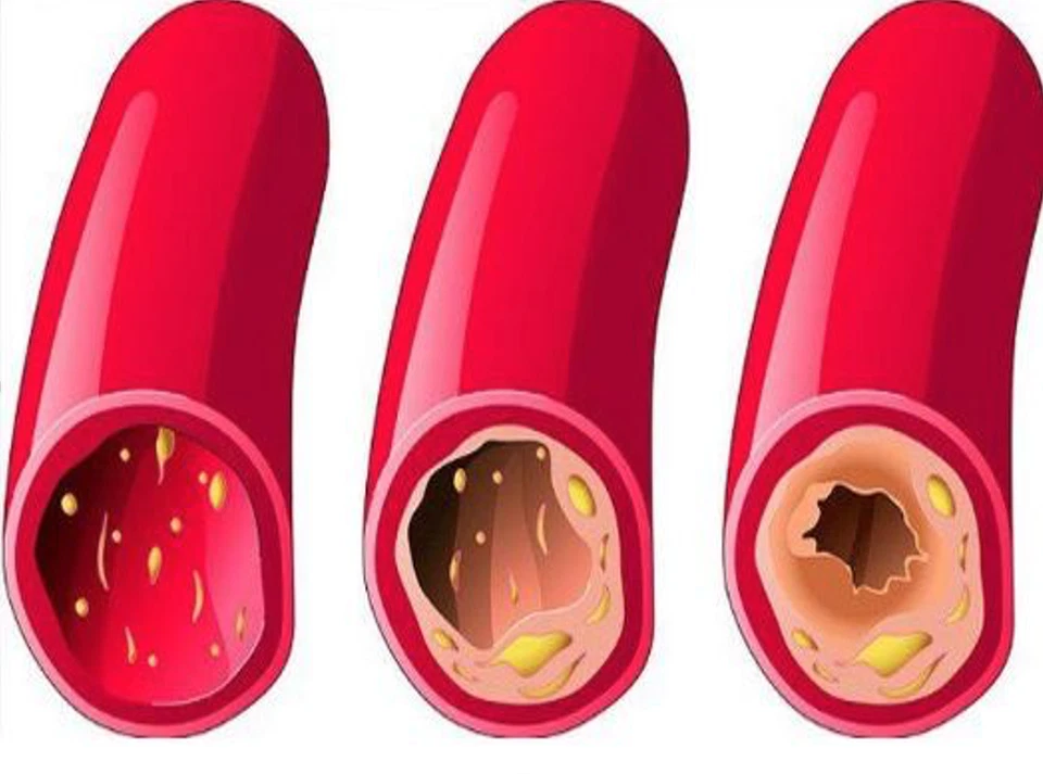 HEARTTOOL bajar la presión arterial en 30 días prevenir ICTUS, TROMBOSIS, COLEST. Foto 3 de 4
