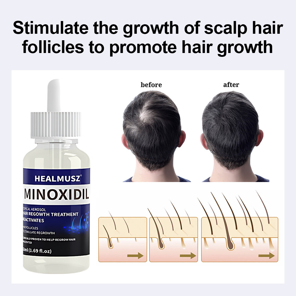 4Pcs Minoxidil 5% Hair Regrowth Treatment Hair Loss &Growth Scalp Liquid For Men