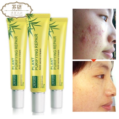 pimple pores removal cream
