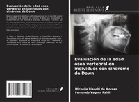 EvaluacióN De La Edad óSea Vertebral En Individuos Con SíNdrome De Down Buch