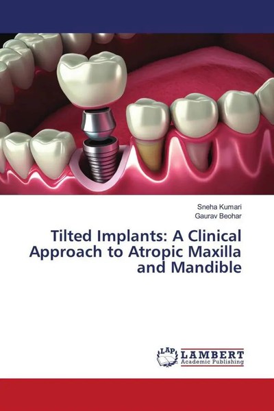Sneha Kumari (U. A.) | Tilted Implants: A Clinical Approach To Atropic...-image