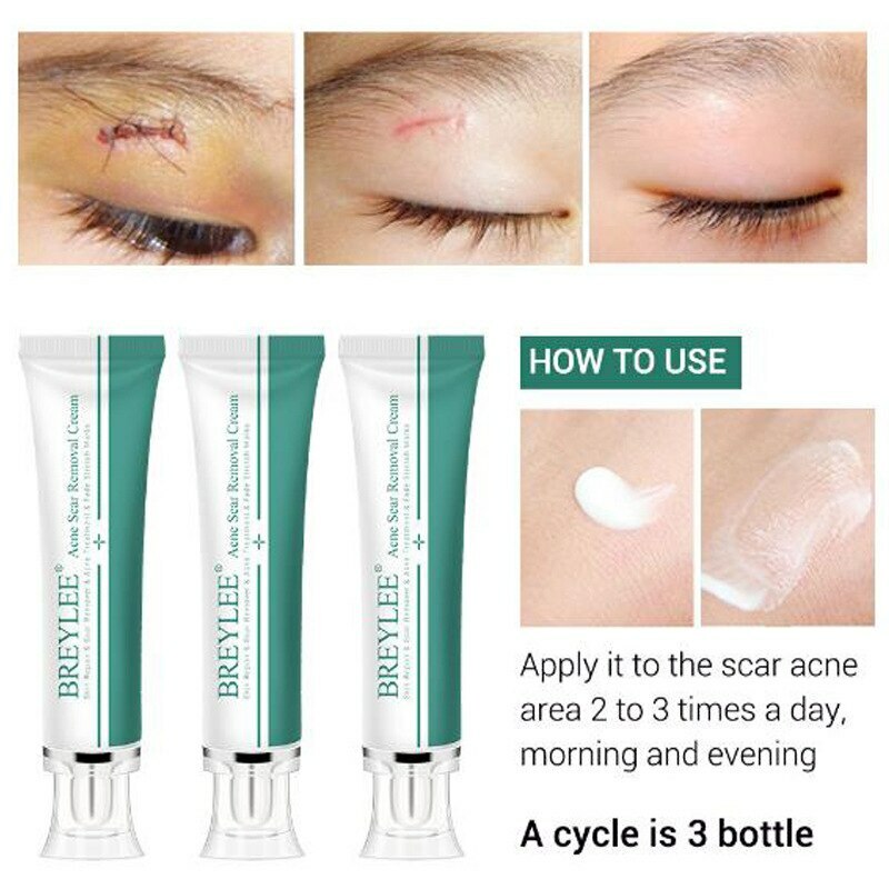 Scar Removal Cream crema eliminación de cicatrices crema facial tratamiento de reparación de la piel