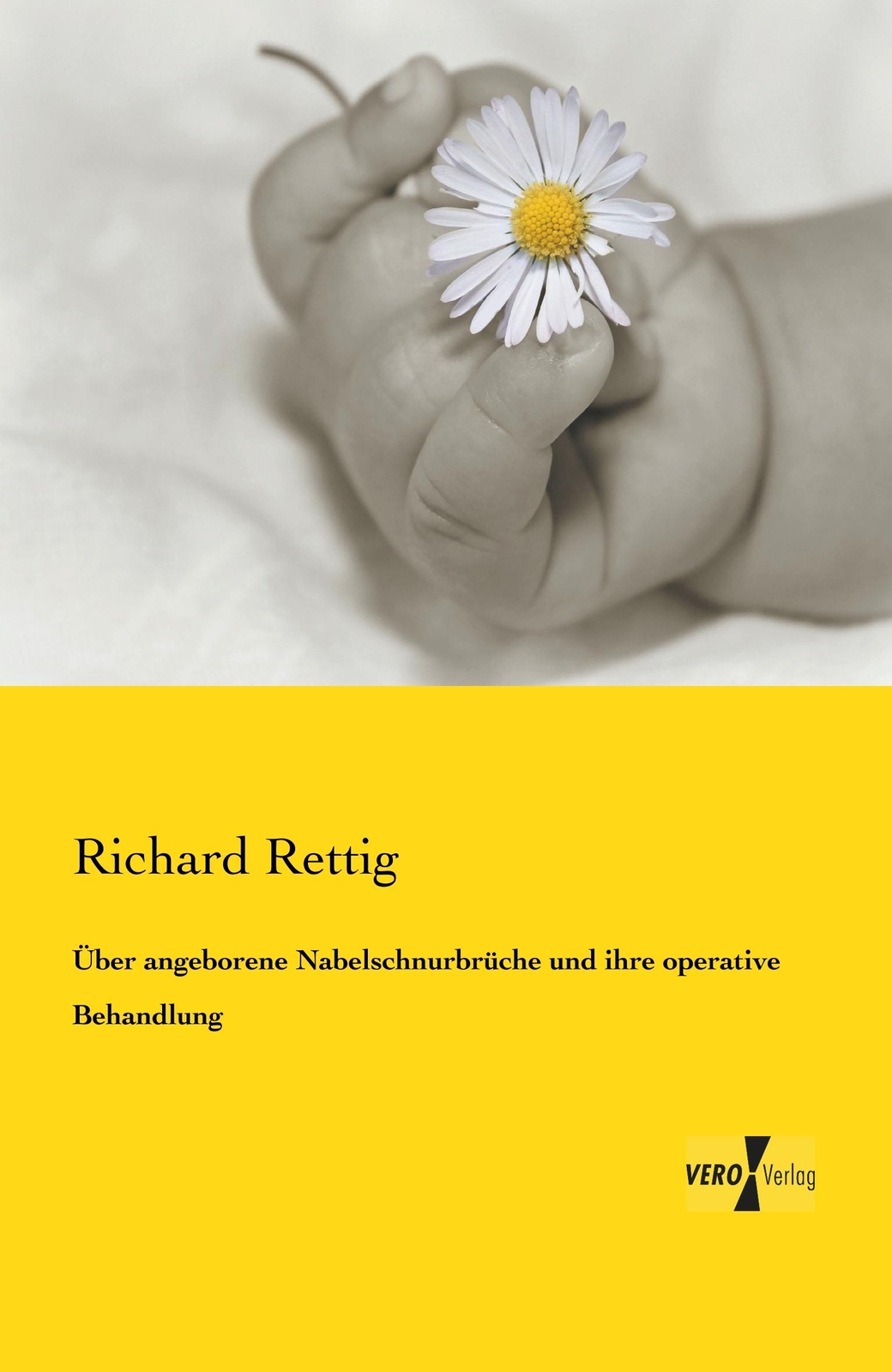 Thumbnail - Über Angeborene Nabelschnurbrüche Und Ihre Operative Behandlung | Buch