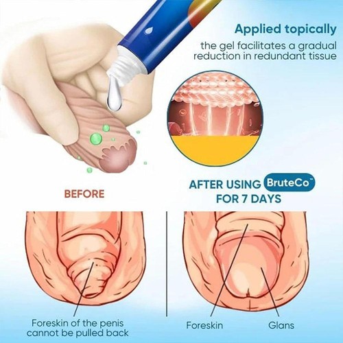 Professional foreskin correction gel for men Excess foreskin correction gelUU - Picture 6 of 10