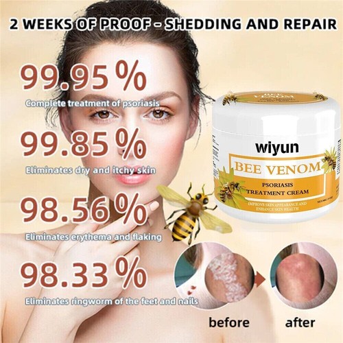 BeeVenom Psoriasis Treatment-Cream Dermatitis Eczema Mild Healing Antibacterial - Picture 9 of 14