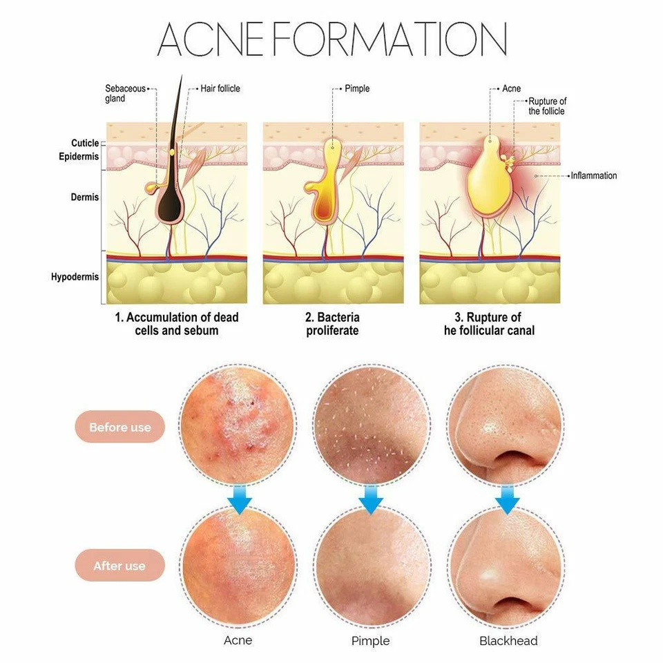 Kit de herramientas removedor de espinillas Pimple Popper comedón herramientas extractor de manchas de acné - Imagen 3 de 4