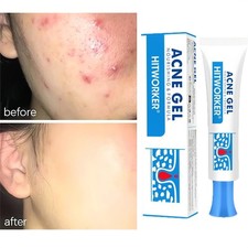 Salicylic Acid Acne Treatment Cream Pimple Spot Repair Deep Pore Cleansing Face