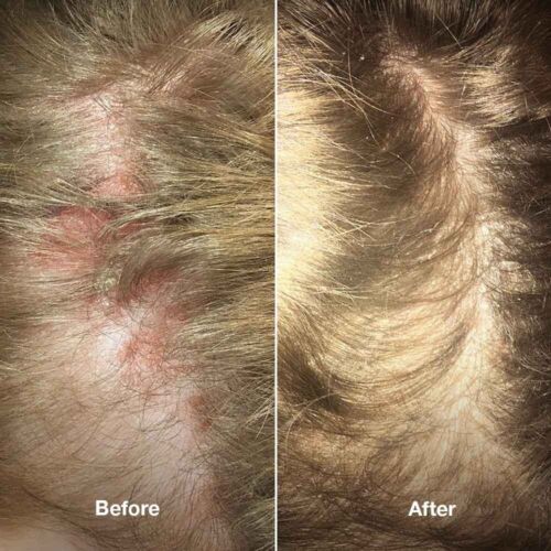 Dermz Healpsorin Therapeutisches Psoriasis Shampoo 500ml Salicylsäure - 2er Pack - Bild 13 von 15