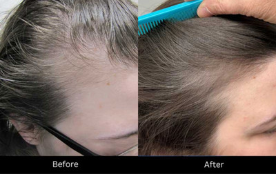 ExoBOOM Exosomes for Hair! 1 set 2 vials adipose-derived Kbeauty 