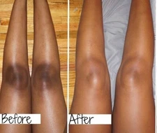 New Strong Whitening Cream For Removing Dark Knuckle Finger Elbow and Knee