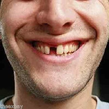 TEMPORARY TOOTH REPLACEMENT, FIX MISSING TOOTH False Tooth Dental Repair