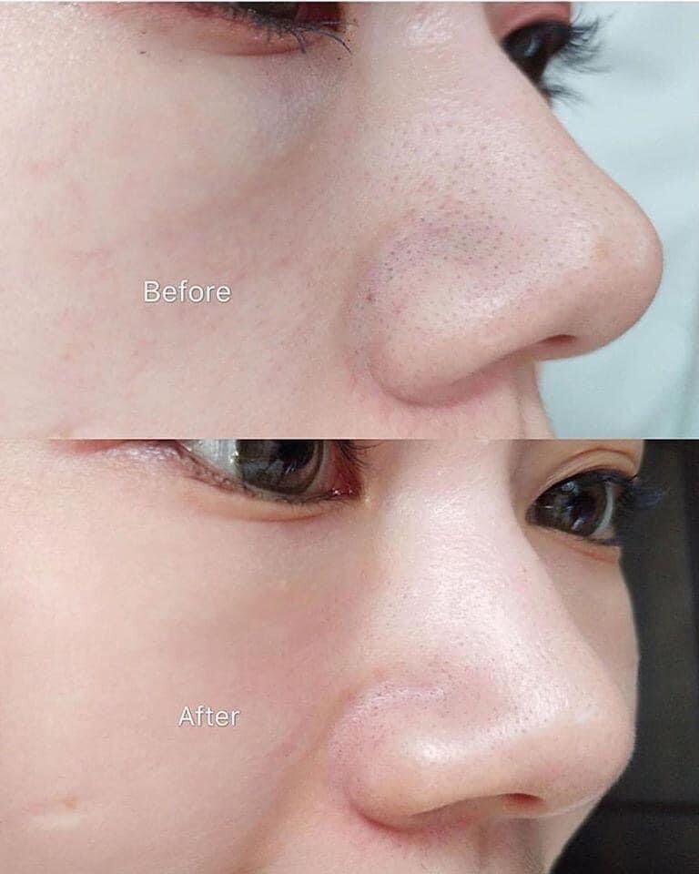 [ILSO]Deep clean master Blackhead Remover Tool Exfoliator 9.5cmx4cm K-Beauty