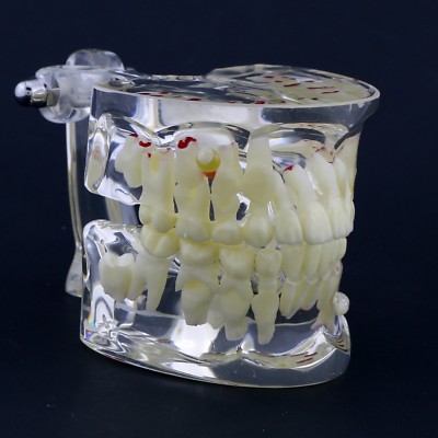 Dental Children Pediatric Pathology Demonstration Study Tooth Teeth Model 4002